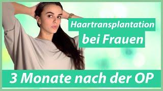 Haartransplantation Frauen Vorher Nachher (3 Monate nach der OP)