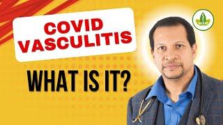 IS Covid Vasculitis a Silent KILLER?