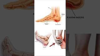 Heel Pain Relief EXERCISE at HOME | Simple Exercise For Plantar Fasciitis | #heelpain #exercise