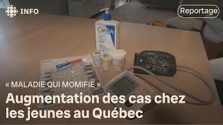 Augmentation des cas de la « maladie qui momifie » au Québec