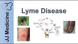 Lyme Disease | Pathophysiology, Signs, and Treatment