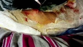 Lipoma excision- surgical closure
