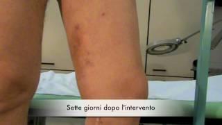 Varici in un uomo , vene varicose stripping laser chiva veneinforma