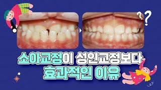 【구로치아교정】 소아교정, 치료 효과를 높일 수 있는 시기는?