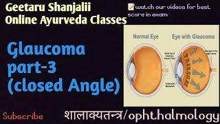 Closed angle glaucoma By geetaru Shanjalii BAMS AYURVEDA shalakyatantra ophthalmology Gitaru ayurved