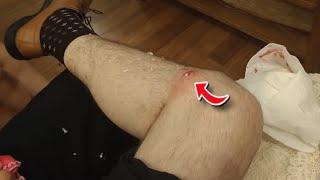 THIS CYST EXPLOSION WAS AMAZING! | Giant Cyst Explosion