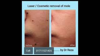 Cosmetic & Laser Treatment by Dr Md Rezaul Islam Hira Dhaka Bangladesh 01711521405