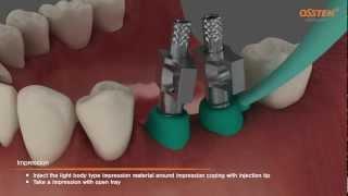 TSIII Fixture Placement & Impression taking (Pick-up and Transfer Impression Copings)