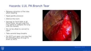 VATS Lobectomy: Prevention and Management of Intraoperative Events