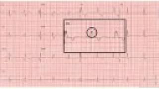 ECG Course 2
