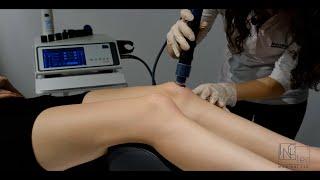 MODUS ESWT SHOCKWAVE PLANTAR FASCIITIS TREATMENT