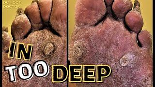 In Too Deep: Removal of Thick, Deep, and Hard Calluses