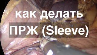 Луцевич: как делать продольную резекцию желудка (Sleeve)