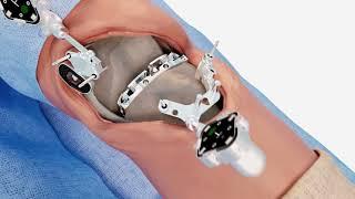 Balanced Knee Replacement Surgery by Exactech