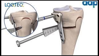 LOQTEQ® High Tibia Osteotomy 4.5 - Surgical Technique