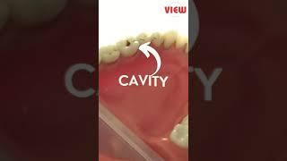 You Need To Fill Your Cavity ASAP! | View Mobile Dental