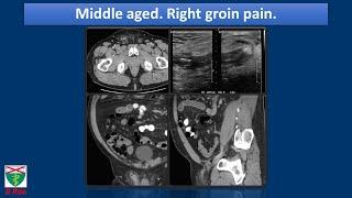 Amyand's hernia with appendicitis