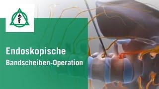 Endoskopische Bandscheiben-Operation | Asklepios