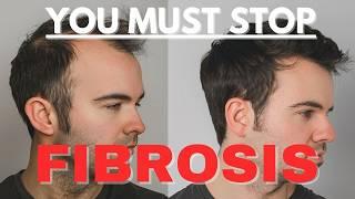 Scalp Fibrosis - Is THIS the Real Reason for Hair Loss in Men?