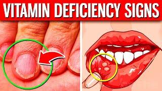 The 10 HIDDEN Signs Of Vitamin Deficiency You Should Never Ignore!