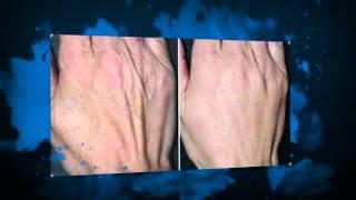 Botox Milton Keynes