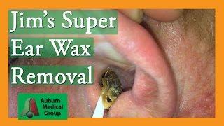 Super Ear Wax Removal with Cerumen-y Goodness | Auburn Medical Group