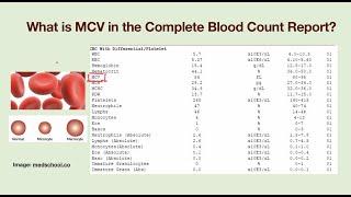 What is MCV? Why my MCV value is abnormal?