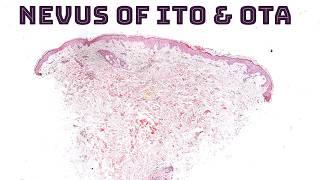 Nevus of Ito, Ota, Sun, Hori & Dermal Melanocytosis ("Mongolian Spot") under the microscope dermpath