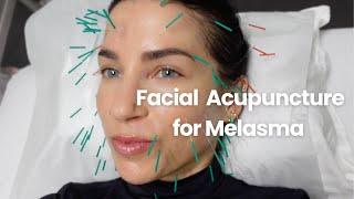 I Tried This Intense Acupuncture Facial, Emsculpt, and K Tip Extensions // A Week in My Life