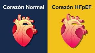 Estudio clínico para aprender más sobre HFpEF (falla cardiaca) e identificar futuros tratamientos