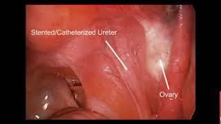 Catheterized Ureter FINAL