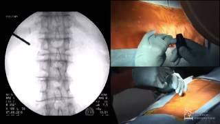 Vertebral Augmentation Lab Demo- Doug Beall, MD