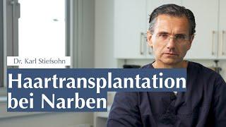 Haartransplantation bei Narben