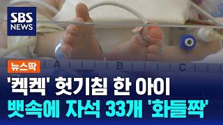 '켁켁' 헛기침 한 아이…뱃속에 자석 33개 '화들짝' / SBS / 뉴스딱
