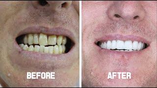 Cosmetic Dentistry (Zirconium Crowns) - Leon from The UK