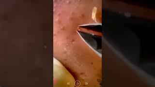 Skincare | Blackheads Removal #489 #tweezers skincare #blackheads blackheads