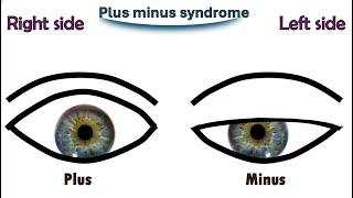 The Plus Minus Syndrome