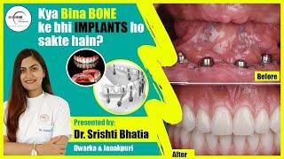 Kya Bina BONE ke Teeth IMPLANTS ho sakte hain? Dr. Srishti Bhatia #teethimplants #implants