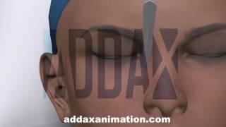 blepharoplasty animation