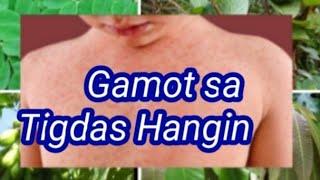 Gamot sa Tigdas Hangin|Solusyon sa kating dulot ng tigdas|Mga Tips Ni Lola