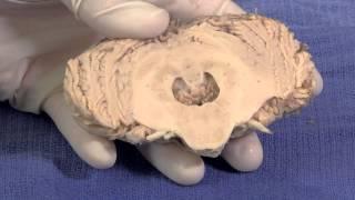 The Cerebellum: Neuroanatomy Video Lab - Brain Dissections