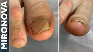 Onycholysis ? Ingrown nail / Installation tamponade