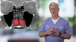 Where are the inferior turbinates located? Atkins Expert Sinus Care ||