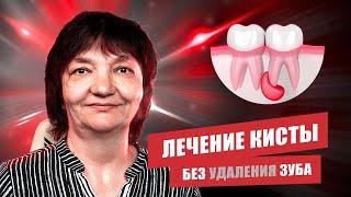  КЕЙС: Лечение кисты без удаления зуба