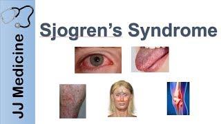 Sjogren’s Syndrome ("Dry Eye Syndrome") | Primary vs. Secondary, Symptoms, Diagnosis and Treatment