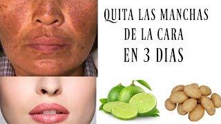 ELIMINA las MANCHAS de la CARA en SOLO 3 NOCHES | REMEDIO CASERO