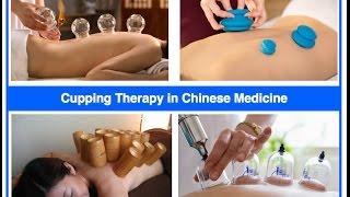 Cupping Therapy in Chinese medicine