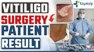 सफेद दाग (Vitiligo) की सर्जरी में कितना खर्चा आता है? Vitiligo Surgery Before and After | Kayakalp