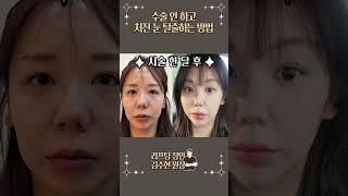내 눈에 신세계가 열리는 법..! #이마실리프팅 #lifting #실리프팅잘하는곳 #실리프팅전후 #오브의원 #김수현원장
