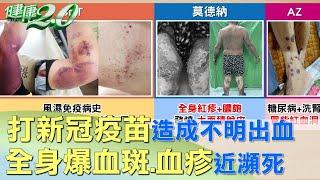 打新冠疫苗造成不明出血 全身爆血斑血疹近瀕死 健康2.0